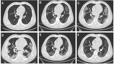 Case Report: A Patient With COVID-19 Who Benefited From Hemoadsorption